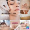 Imagem do Produto Pack de Posts Prontos para Acupuntura com Artes Editáveis no Canva