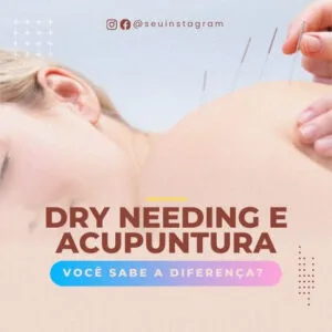 Imagem do Produto Pack de Posts Prontos para Acupuntura com Artes Editáveis no Canva